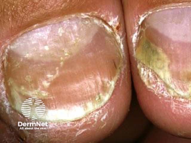 Nail psoriasis