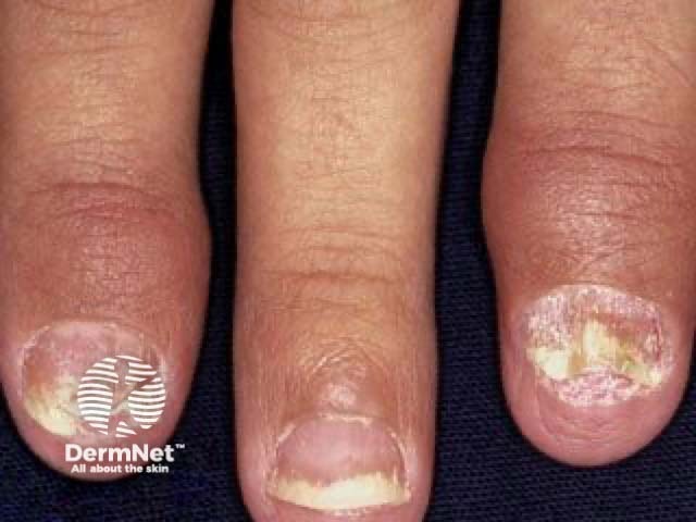 Nail psoriasis