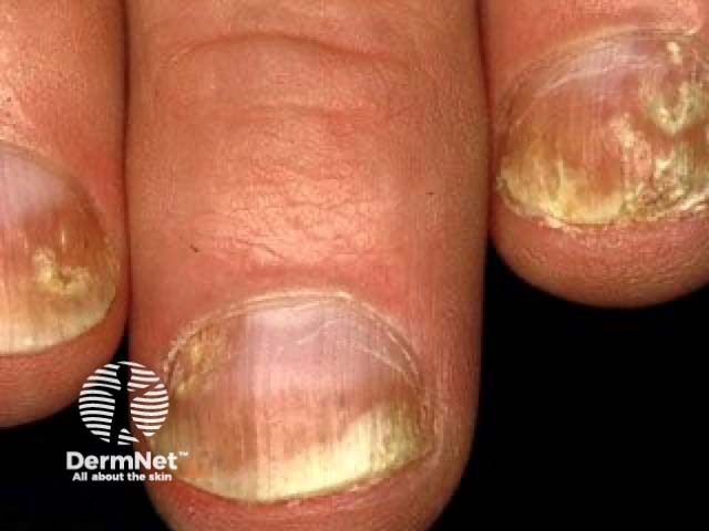 Nail psoriasis