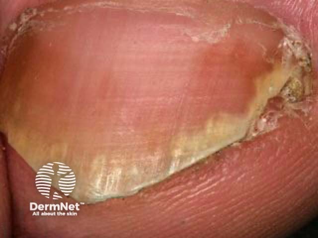 Nail psoriasis