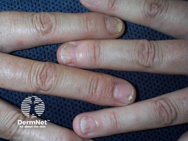 Nail psoriasis