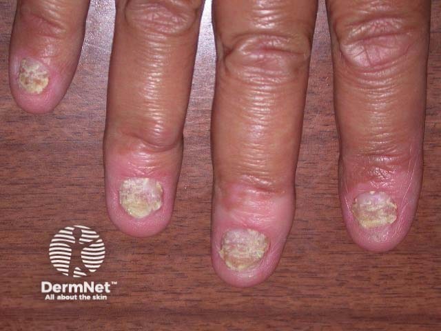 Nail psoriasis