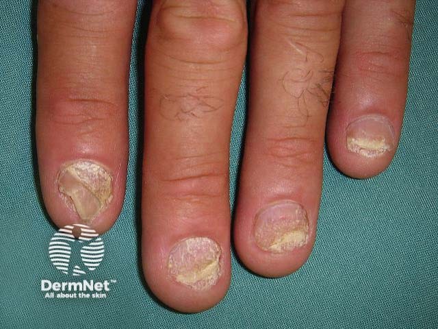 Nail psoriasis