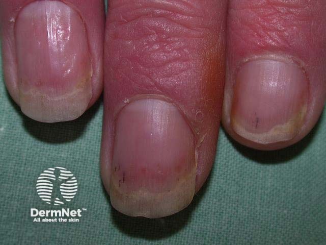 Nail psoriasis