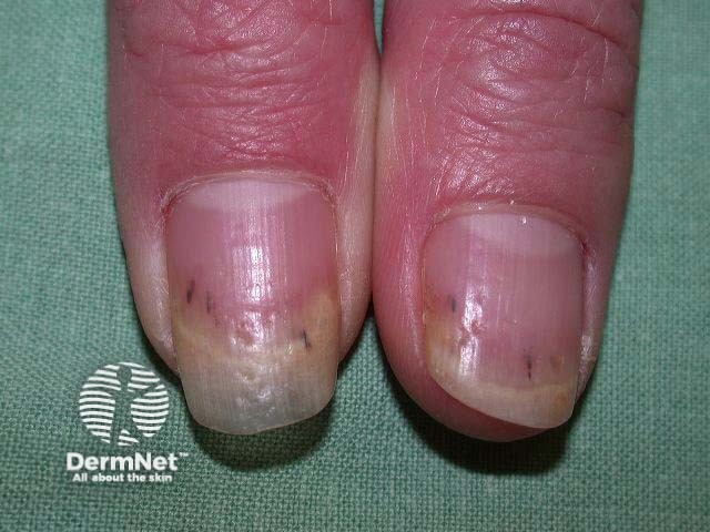 Nail psoriasis