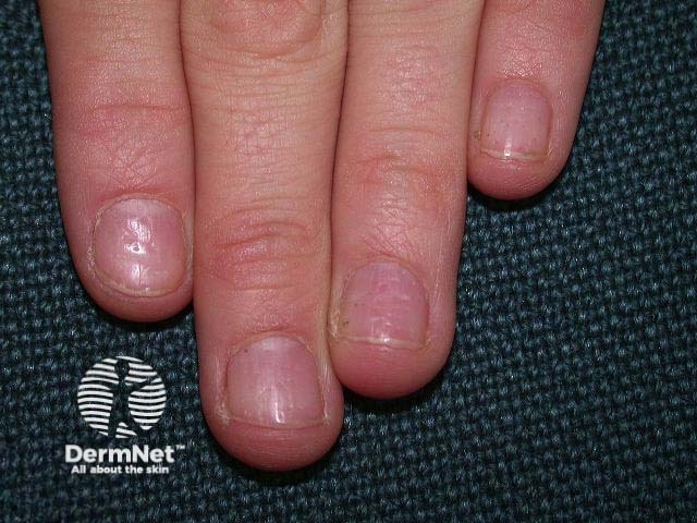 Nail psoriasis