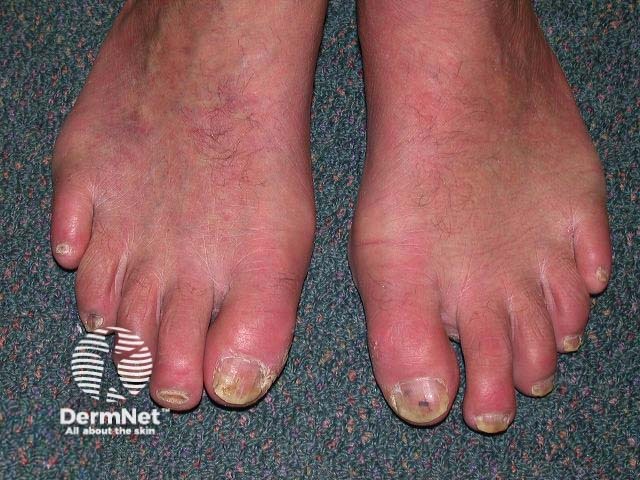 Nail psoriasis