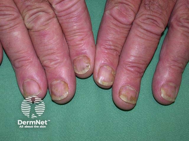 Nail psoriasis