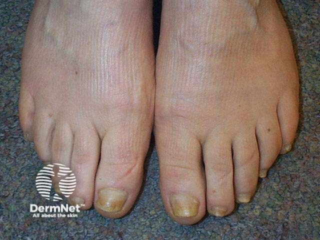 Nail psoriasis