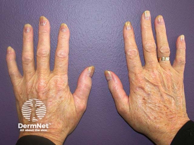 Nail psoriasis