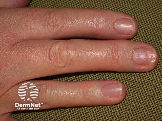 Nail psoriasis