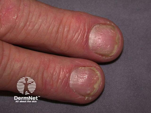 Nail psoriasis