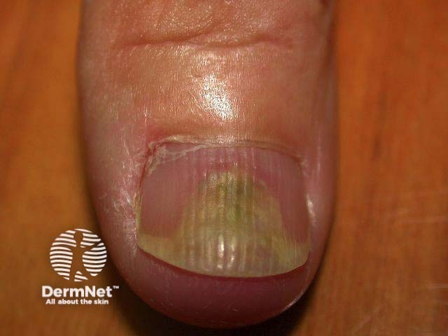 Nail psoriasis