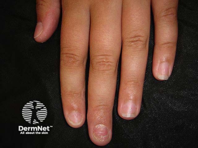 Nail psoriasis