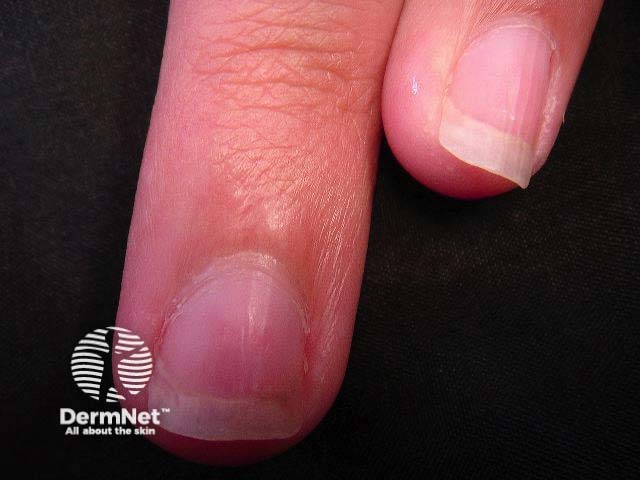 Nail psoriasis