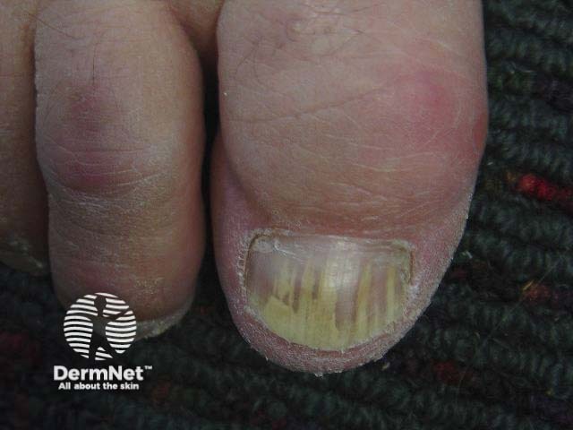 Nail psoriasis