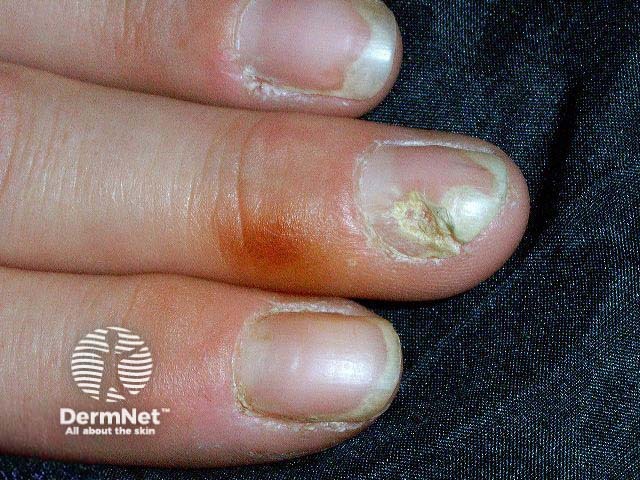 Nail psoriasis