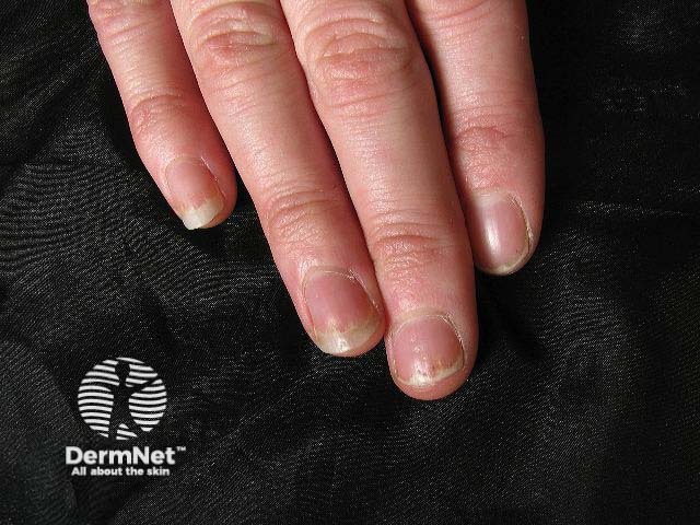 Nail psoriasis