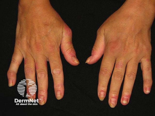 Periungual psoriasis and paronychia