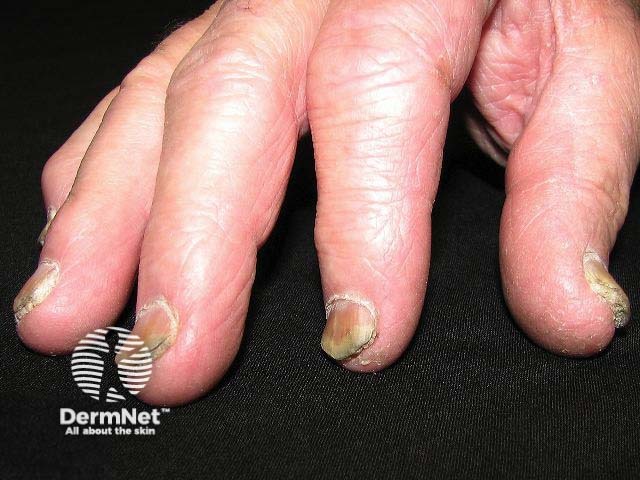 Nail psoriasis