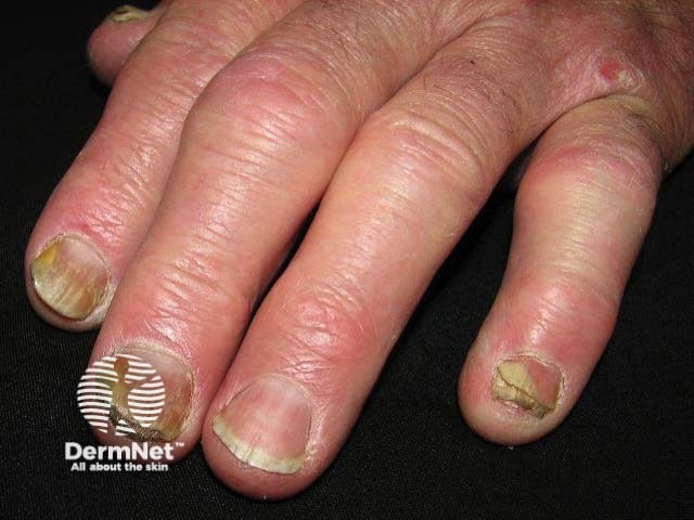 Nail psoriasis