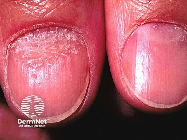 Nail psoriasis