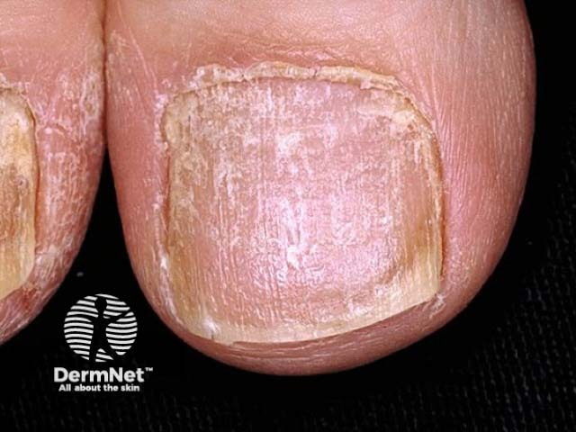 Nail psoriasis