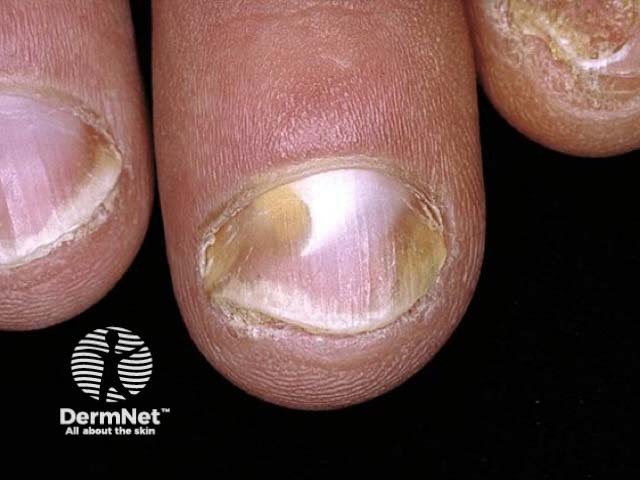 Nail psoriasis