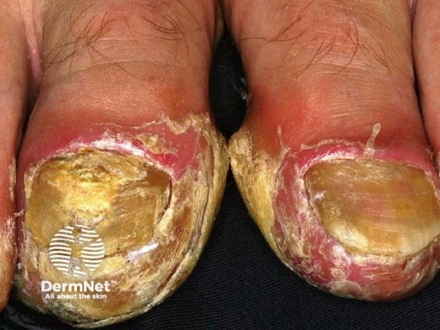 Nail psoriasis