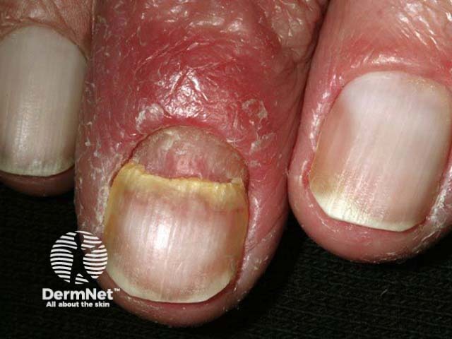 Nail psoriasis