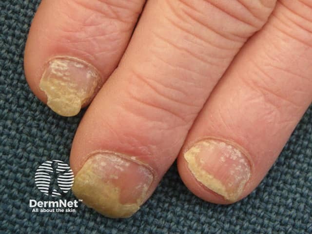 Nail psoriasis