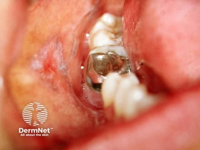 Lichenoid reaction to amalgam