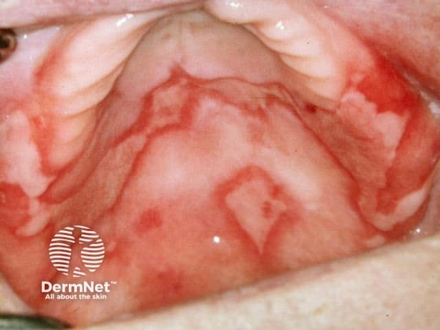 Lichenoid drug reaction