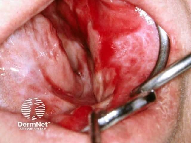 Oral lichen planus