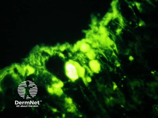 Lichenoid inflammation