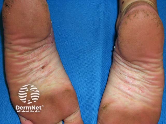 Palmoplantar psoriasis