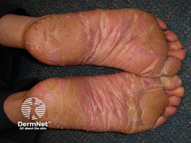 Palmoplantar psoriasis