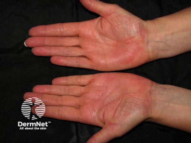 Palmoplantar psoriasis