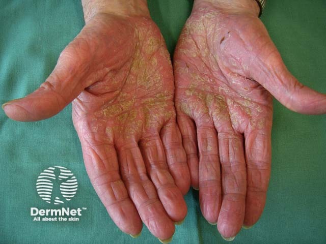 Palmoplantar psoriasis