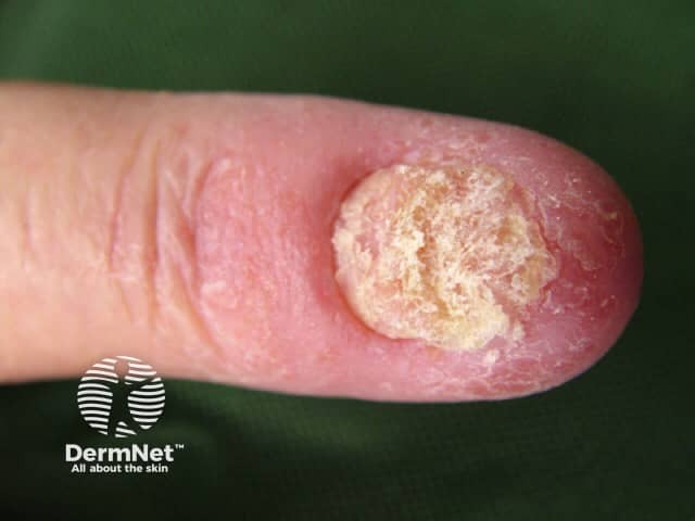 Parakeratosis pustulosa