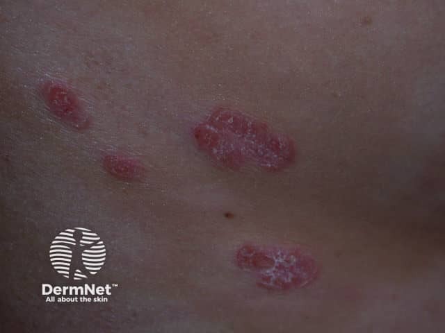 Psoriasis