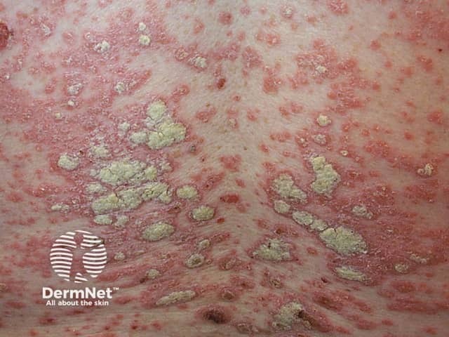 Chronic plaque psoriasis