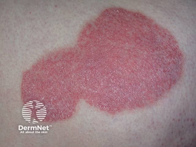 Chronic plaque psoriasis