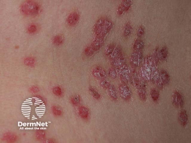 Chronic plaque psoriasis