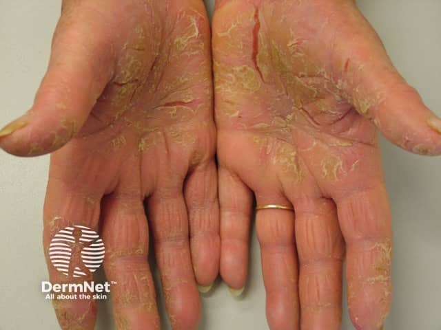 Palmoplantar psoriasis