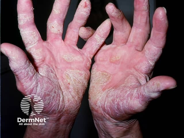 Palmoplantar psoriasis