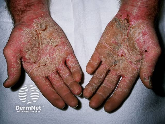 Palmoplantar psoriasis