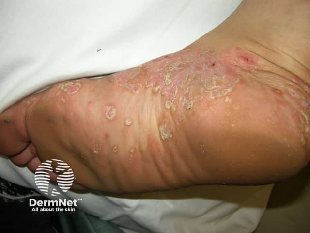 Palmoplantar psoriasis