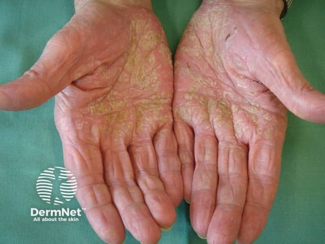 Palmoplantar psoriasis