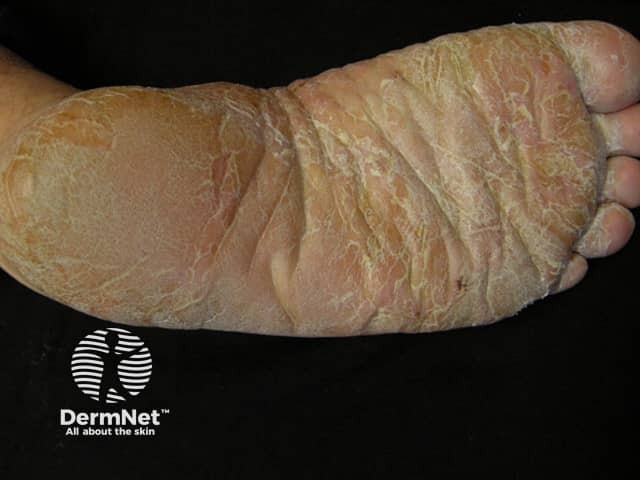 Palmoplantar psoriasis